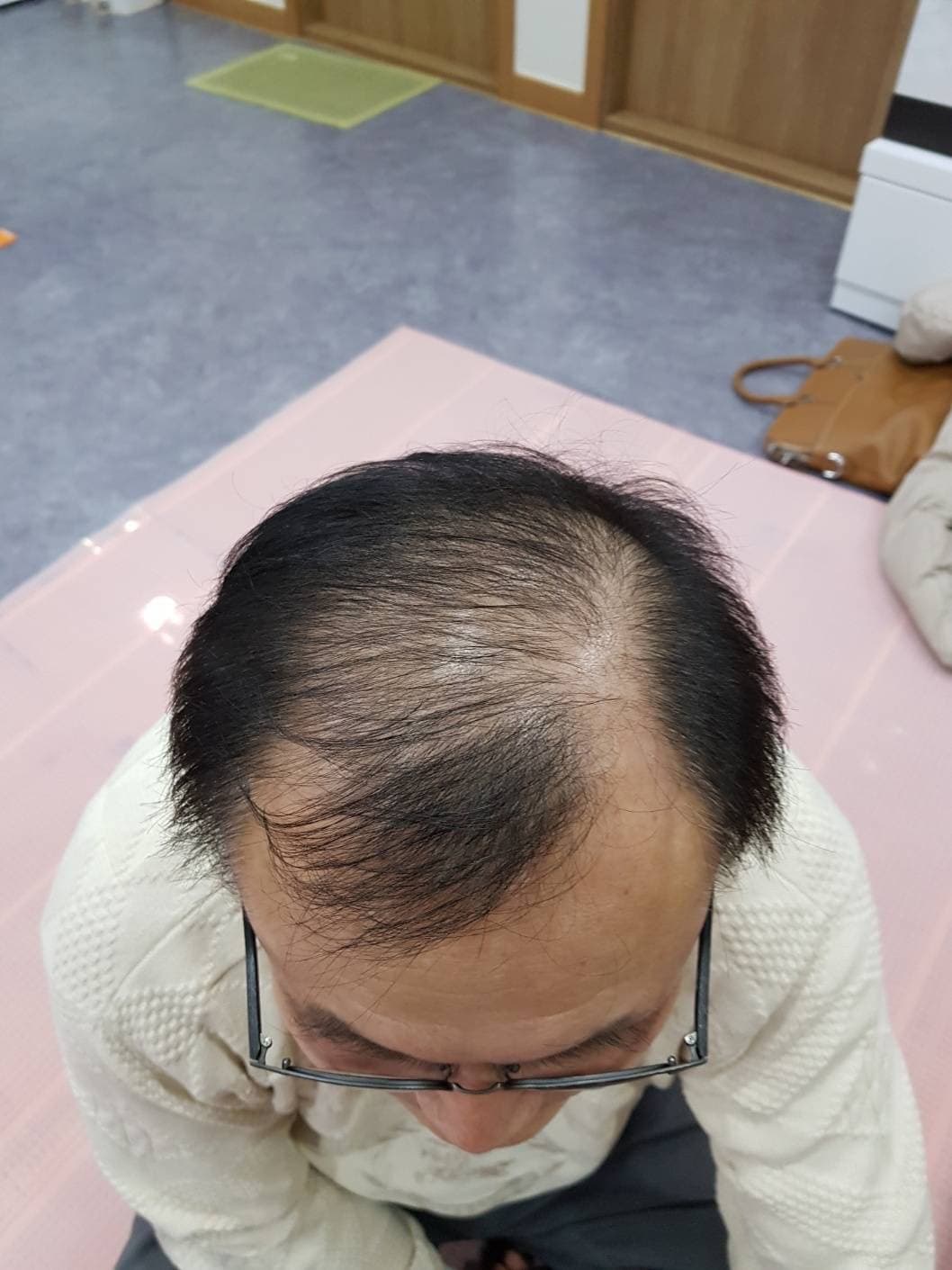 脱毛改善(男性) 施術前