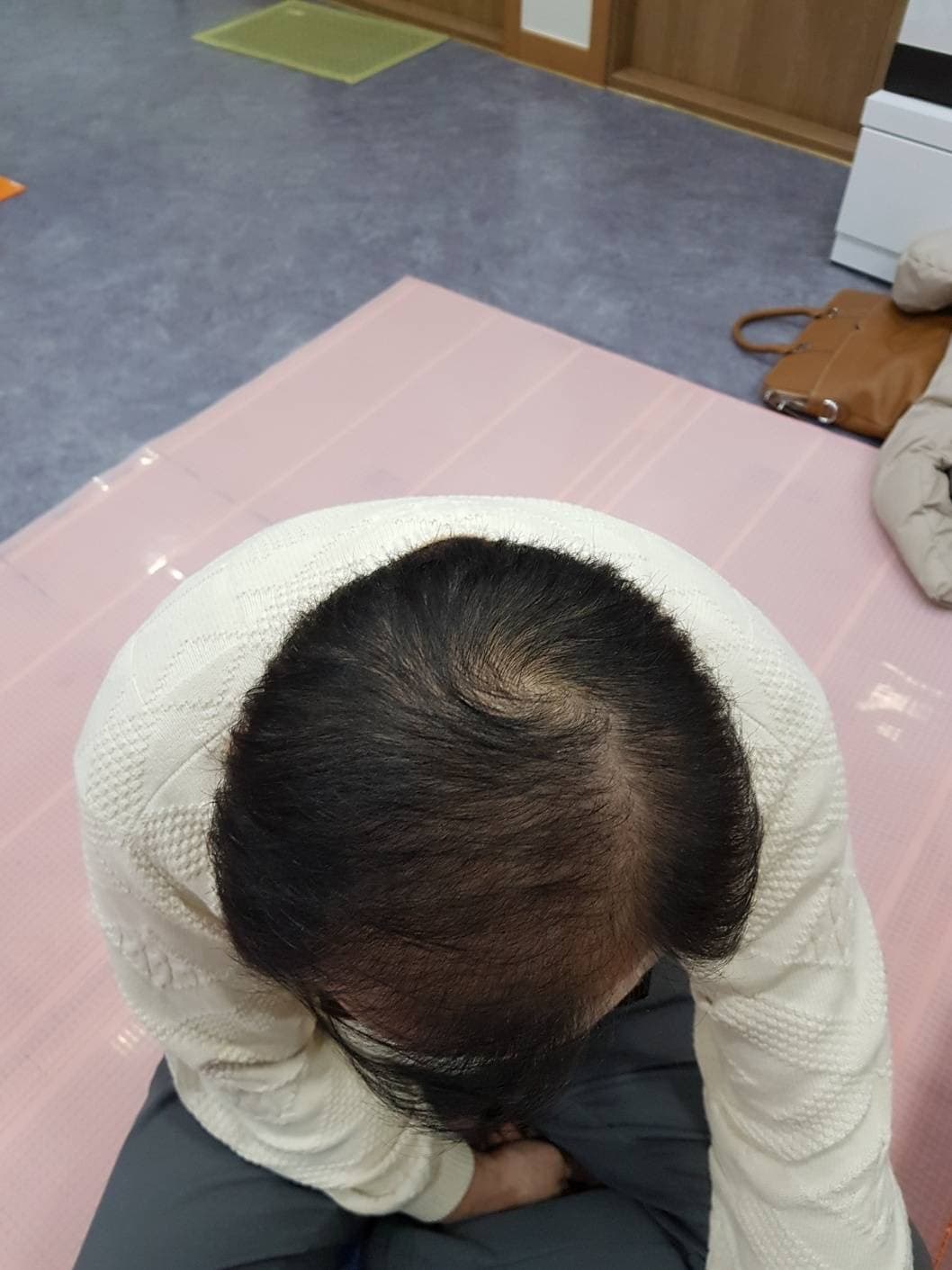 脱毛改善(男性) 施術後