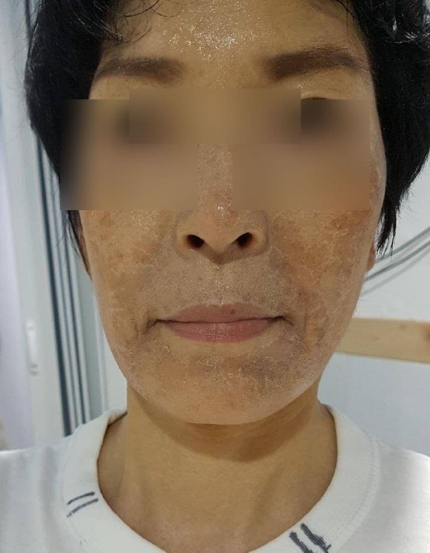 顔の皮膚改善 施術前