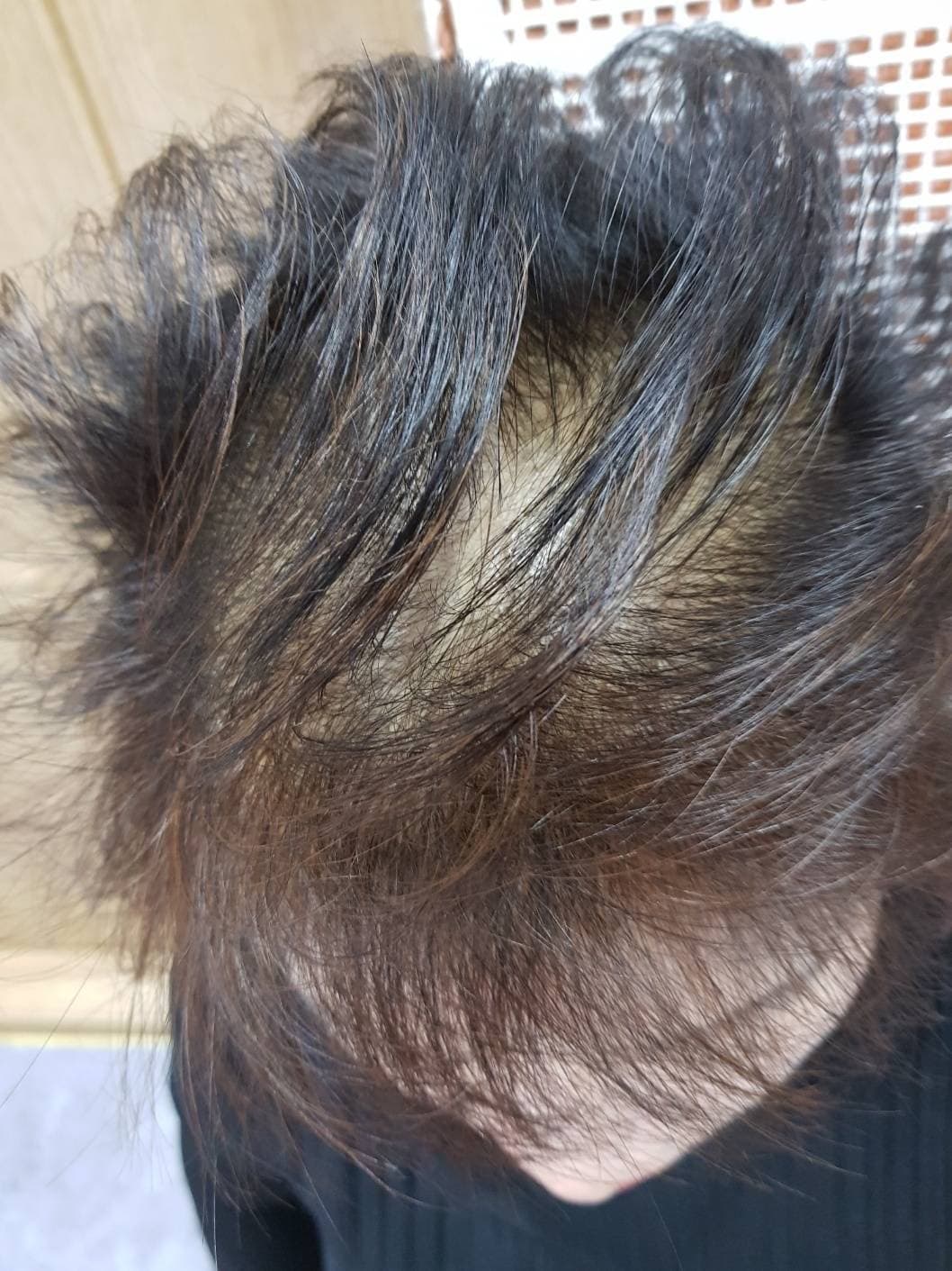 薄毛改善(女性) 施術前