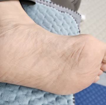 足裏の改善 施術後